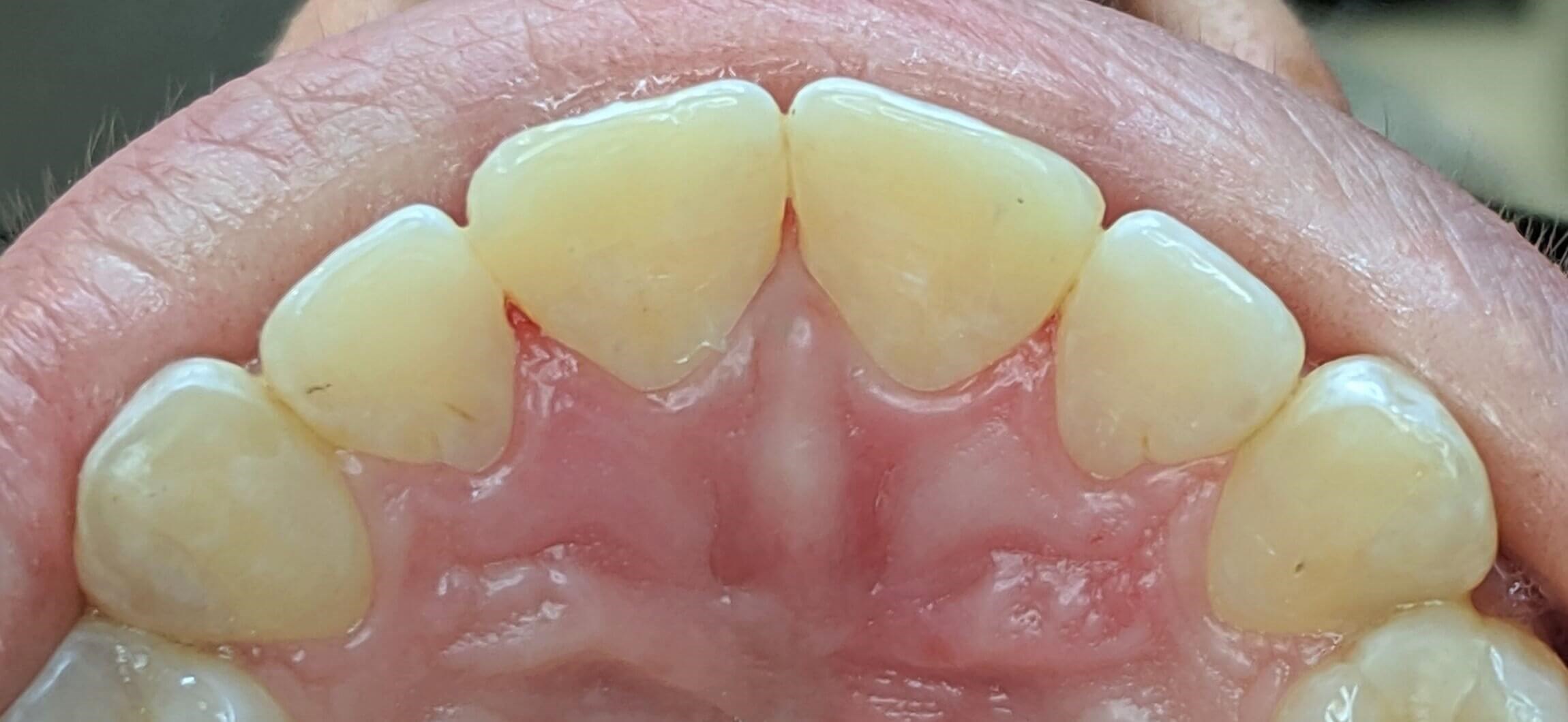 Filling before and after After Filling before and after After