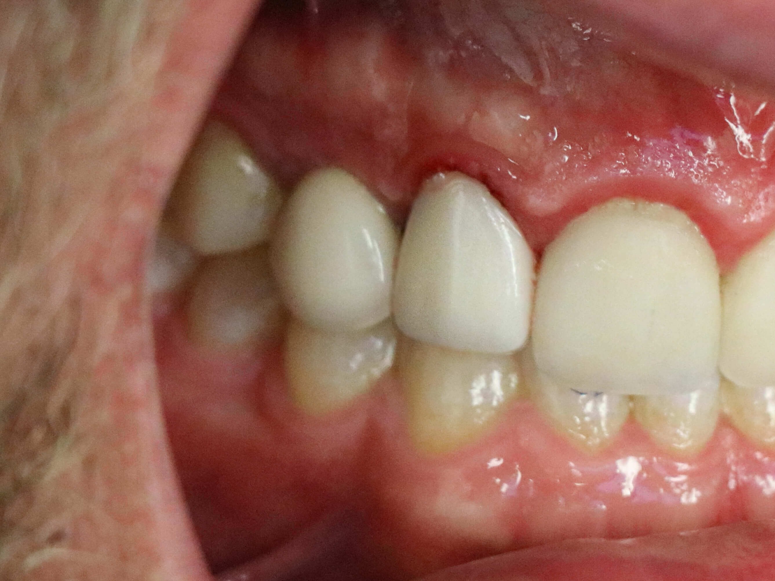 Anterior All Ceramic Crown #7 After