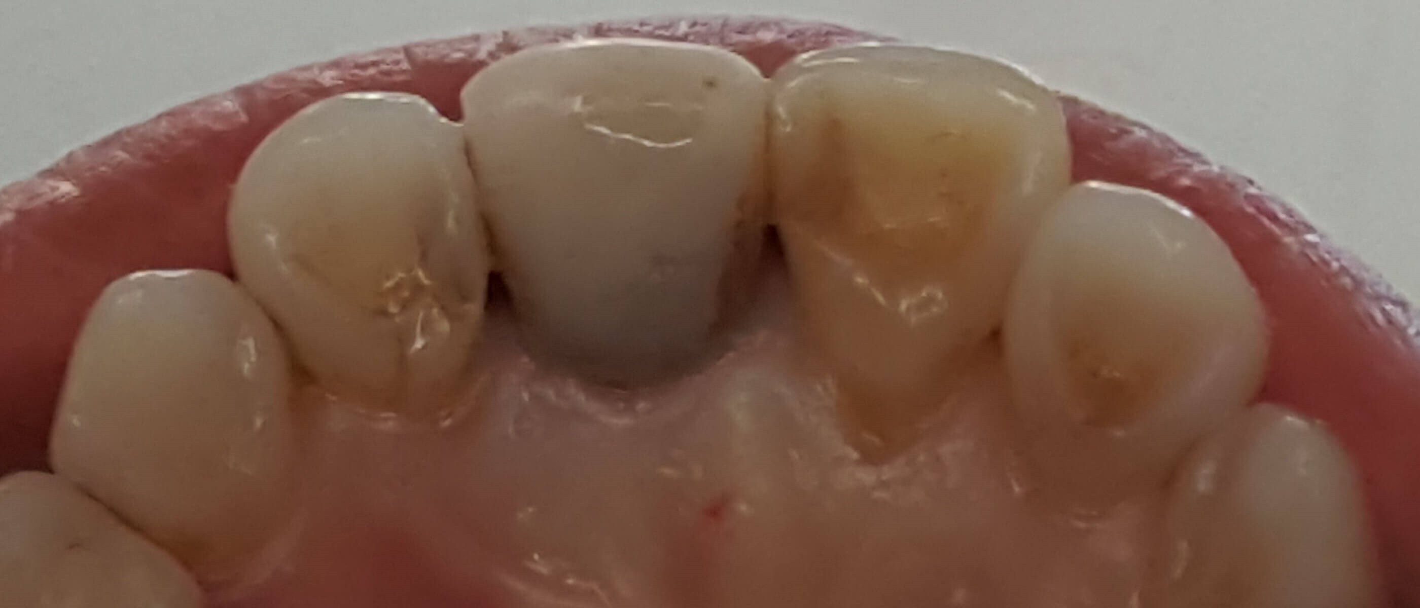 All Ceramic Crown 8/9 Before