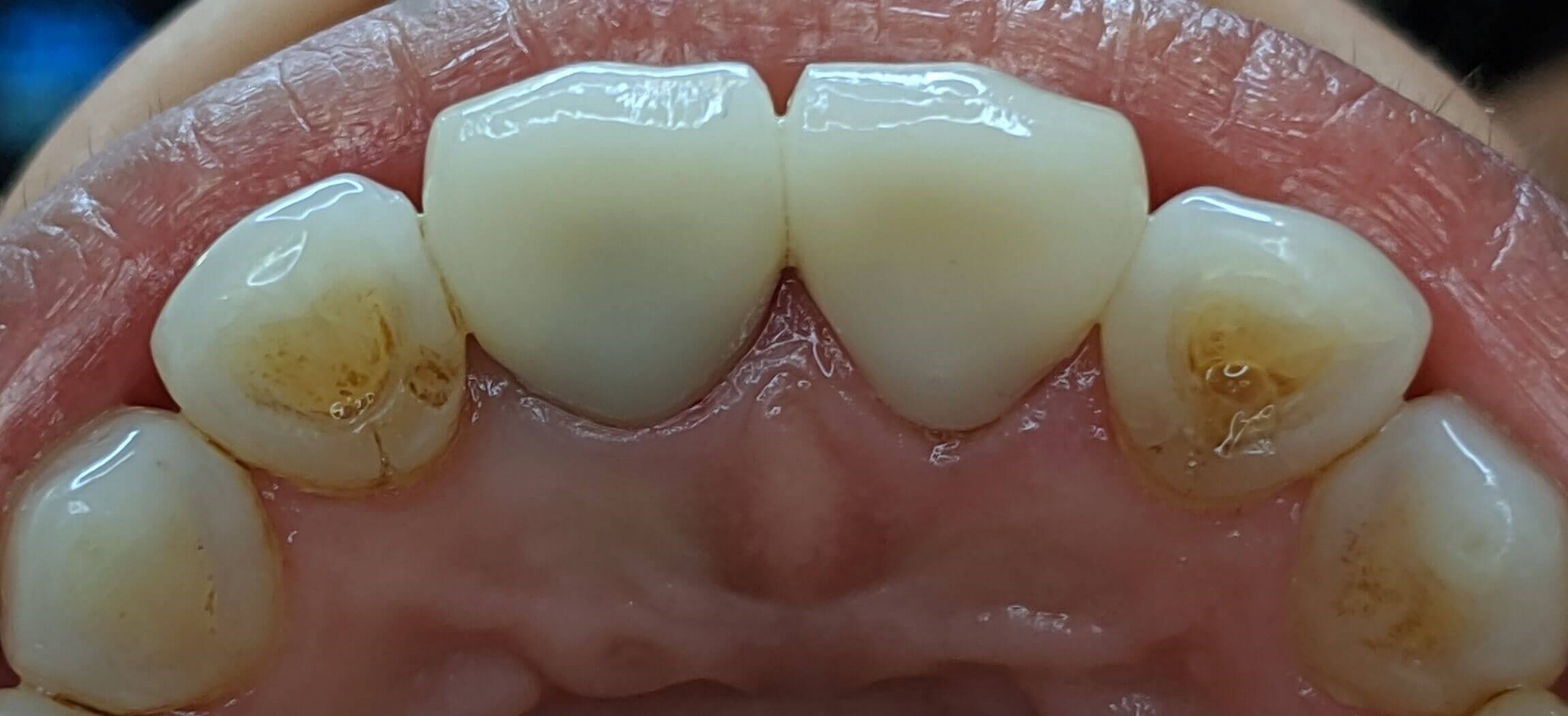 All Ceramic Crown 8/9 After