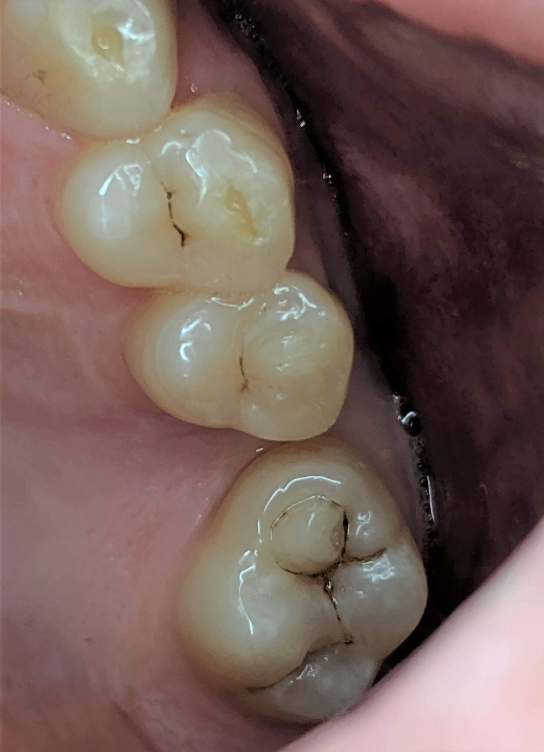 Fillings before and after Before