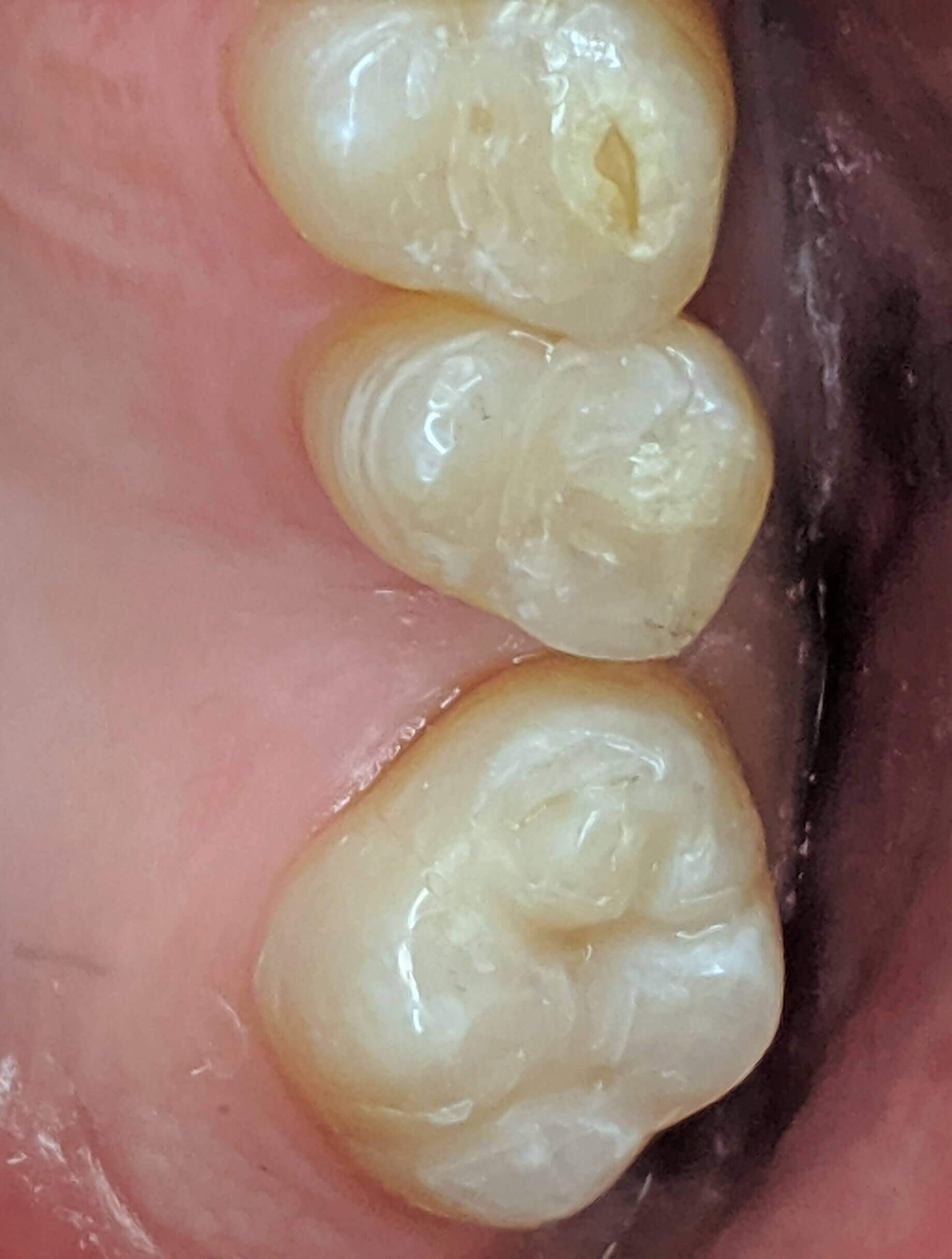 Fillings before and after After