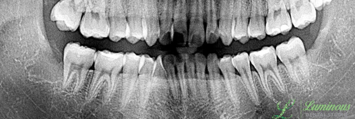 Extraction Before and After After